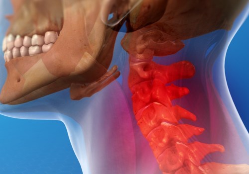 How Long Does it Take for Whiplash Symptoms to Show Up?