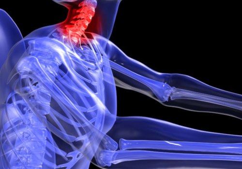 Is Minor Whiplash Serious? A Comprehensive Guide